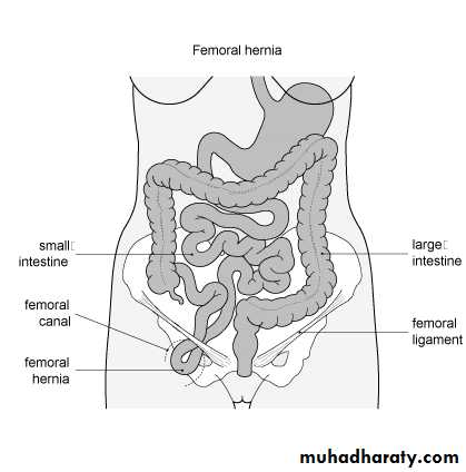 Abdominal wall Hernia