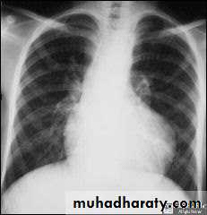 Cynotic congenital heart disease