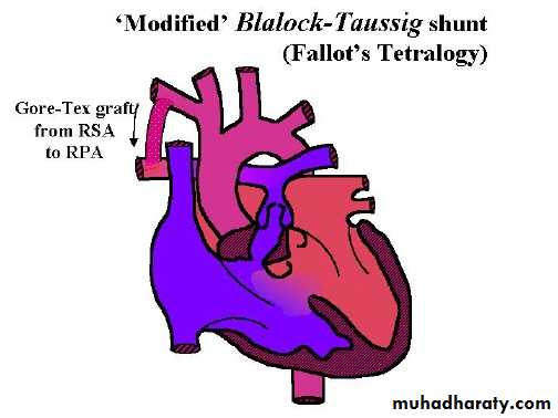 Cynotic congenital heart disease