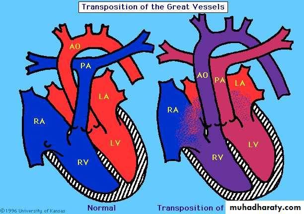 Cynotic congenital heart disease