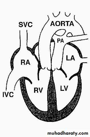 Cynotic congenital heart disease