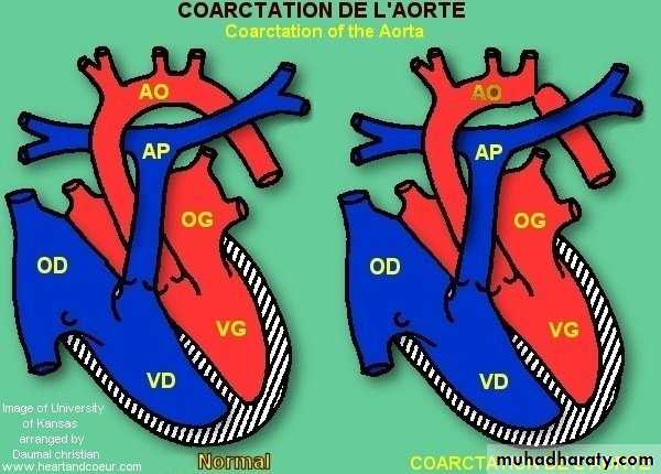 Cynotic congenital heart disease