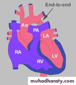 Cynotic congenital heart disease