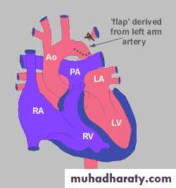 Cynotic congenital heart disease