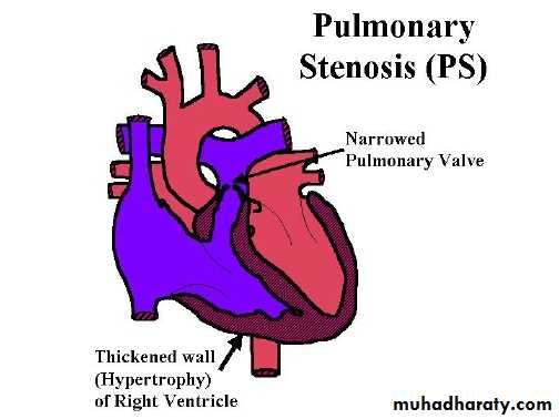 Cynotic congenital heart disease