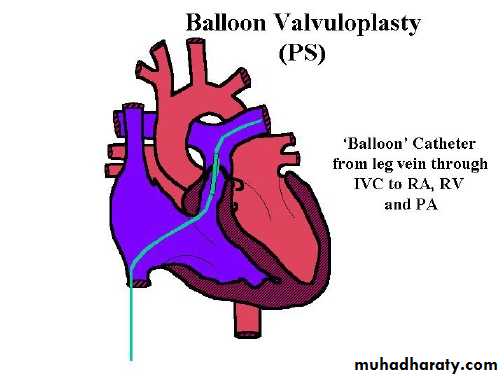 Cynotic congenital heart disease
