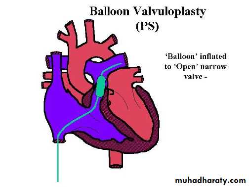 Cynotic congenital heart disease