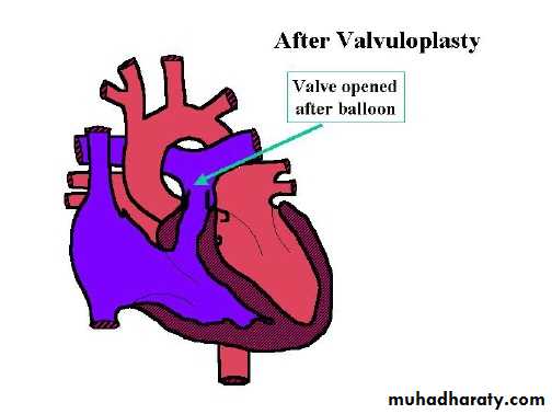 Cynotic congenital heart disease