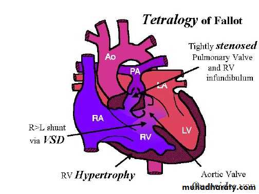 Cynotic congenital heart disease