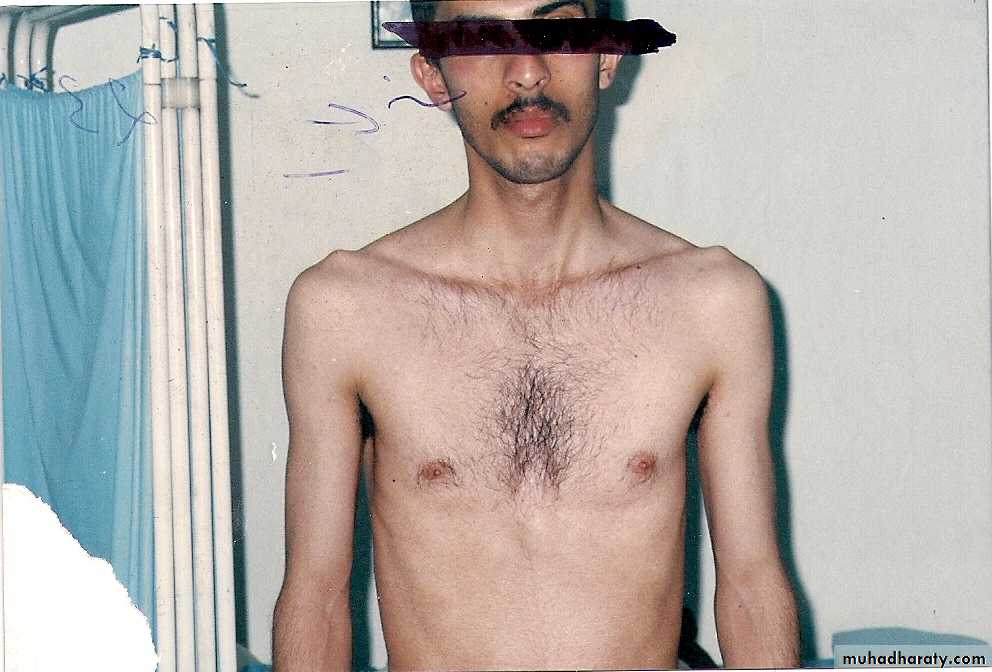 Eating Disorders