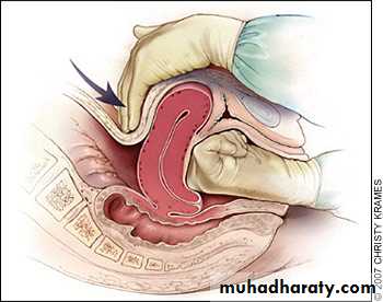 Abnormalities of the third stage of labor