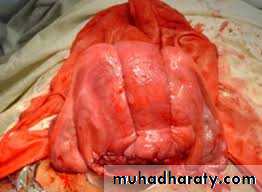 Abnormalities of the third stage of labor