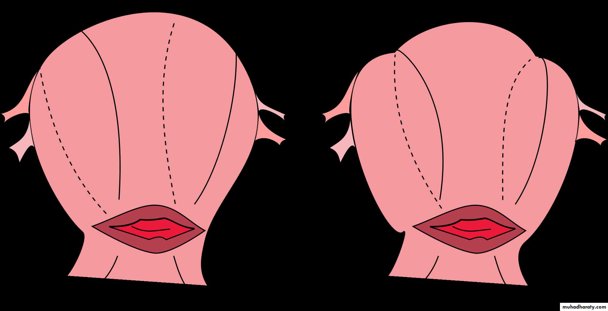 Abnormalities of the third stage of labor