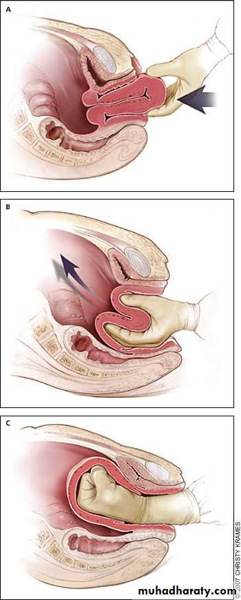 Abnormalities of the third stage of labor
