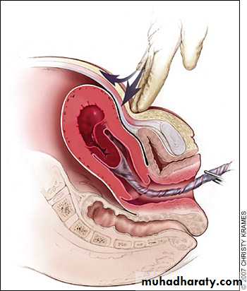 Abnormalities of the third stage of labor