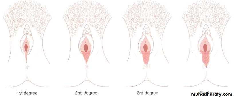 Operative Intervention in Obstetrics