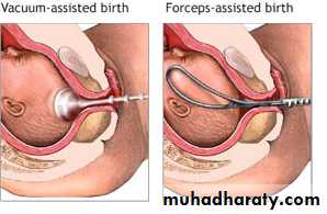 Operative Intervention in Obstetrics