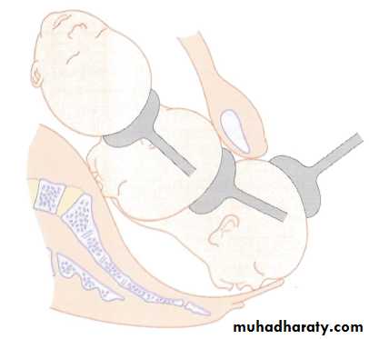 Operative Intervention in Obstetrics