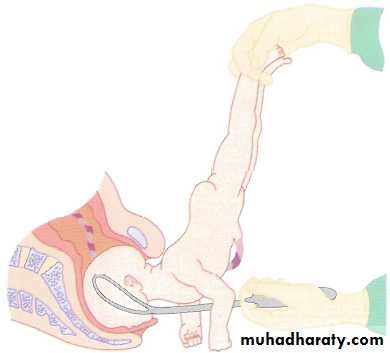 Operative Intervention in Obstetrics