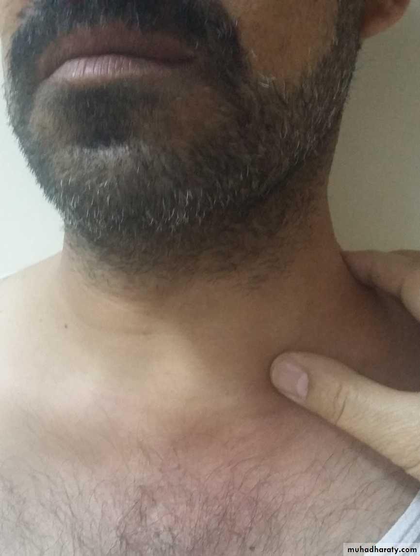Cervical Lymph Nodes