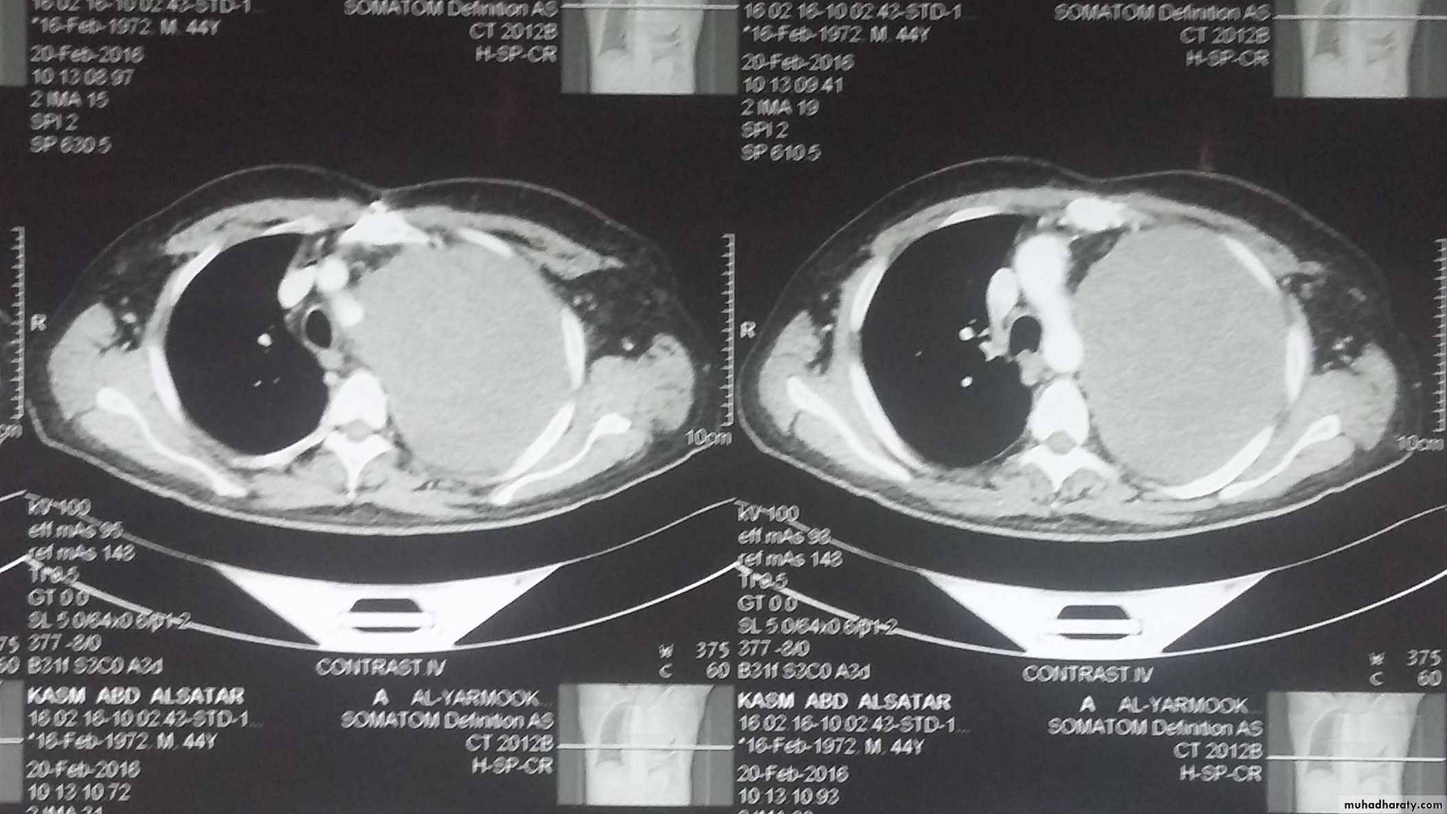Cervical Lymph Nodes
