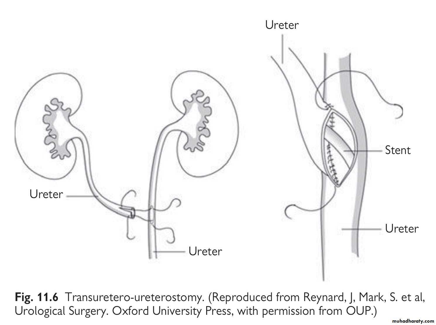 Renal trauma