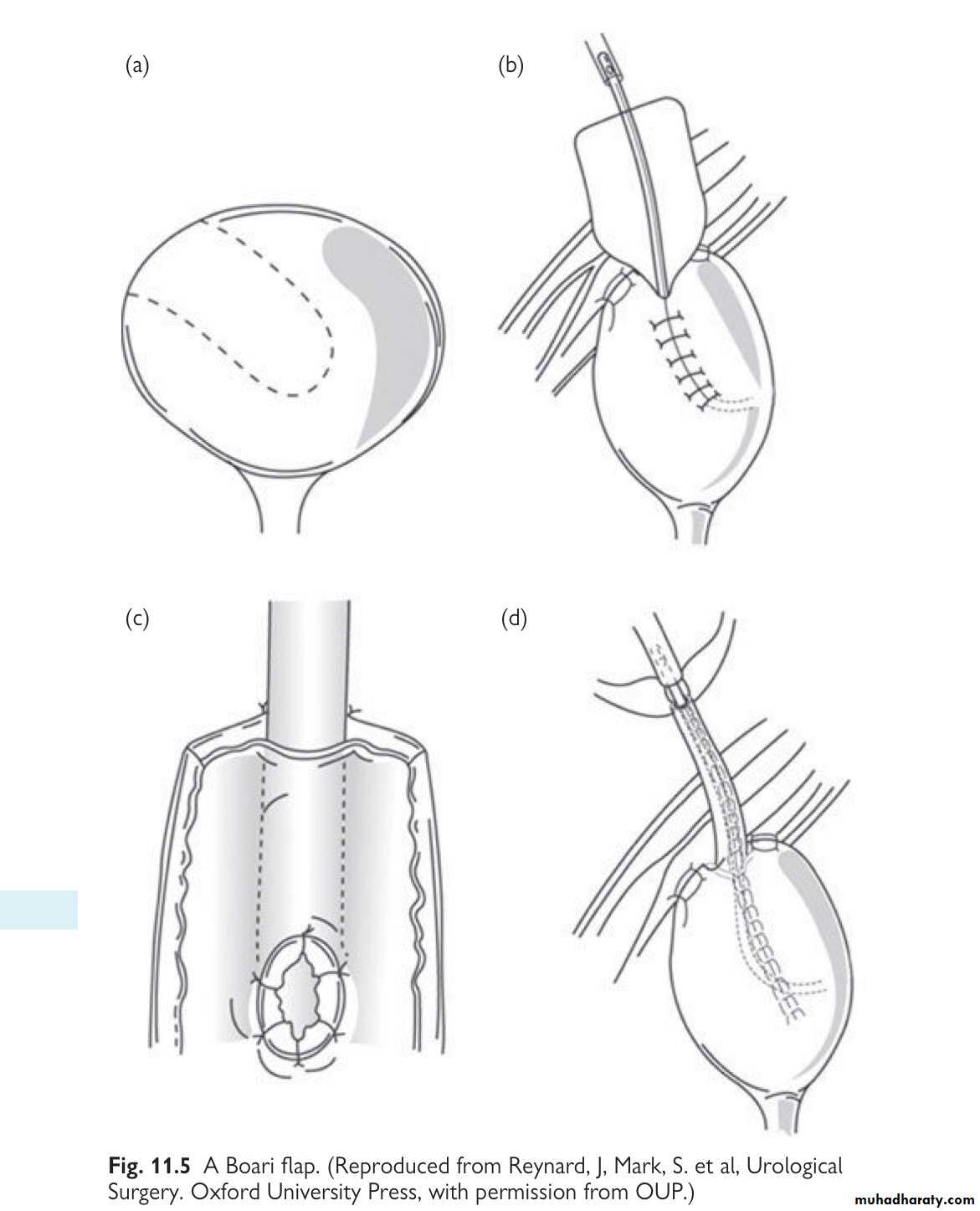 Renal trauma