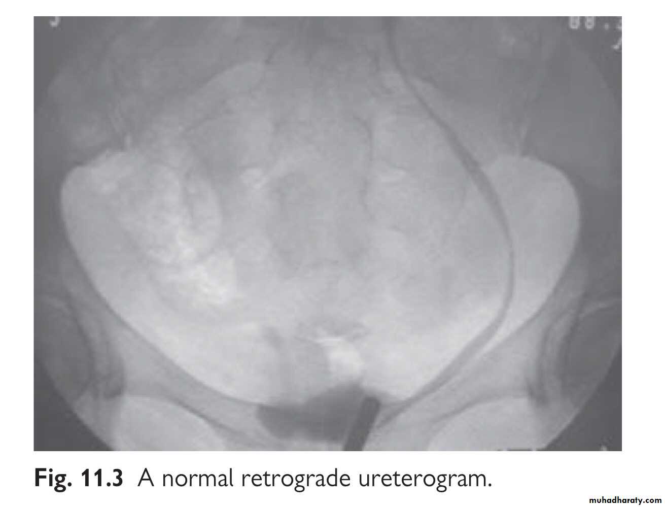Renal trauma