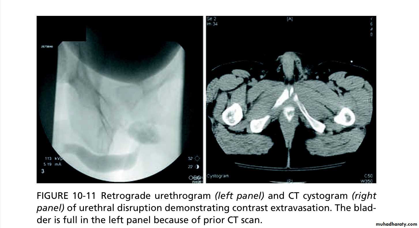 Renal trauma