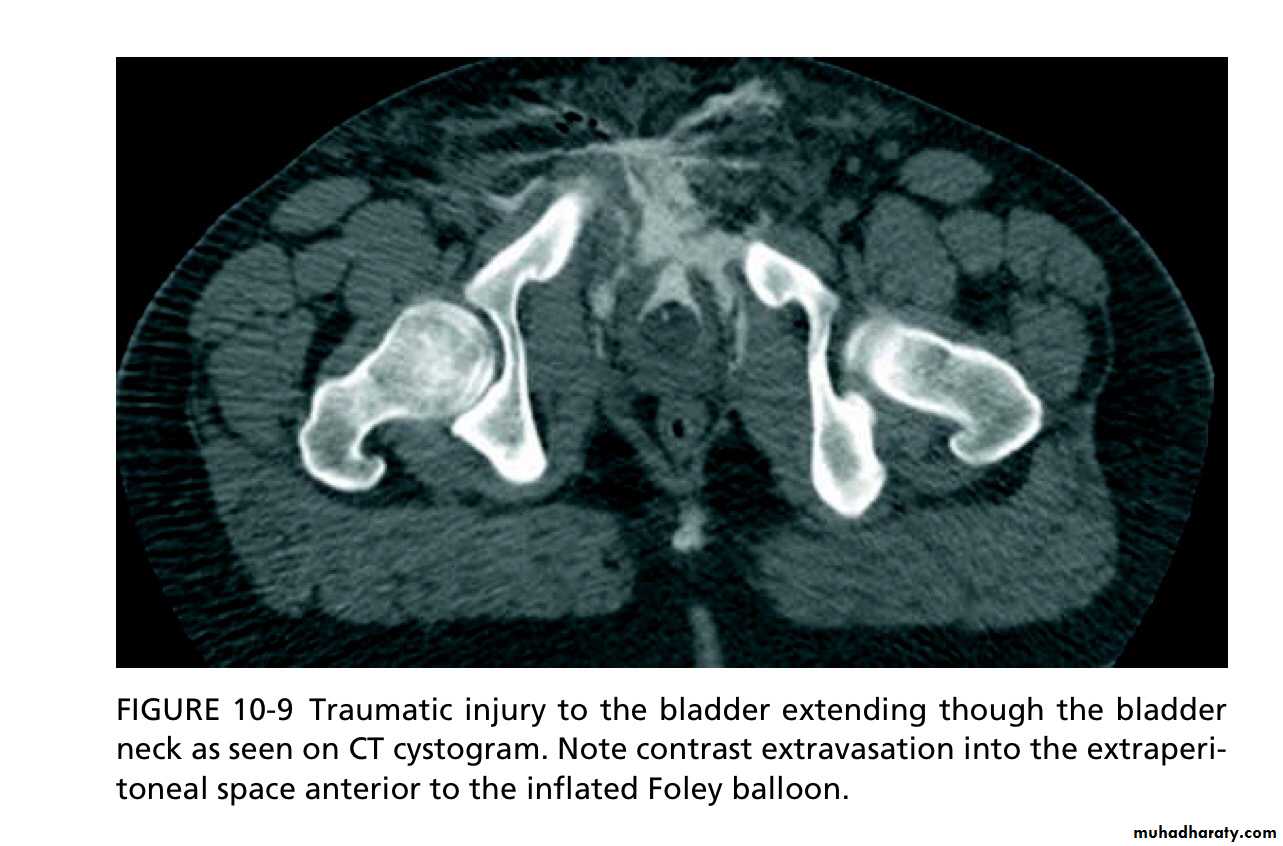 Renal trauma