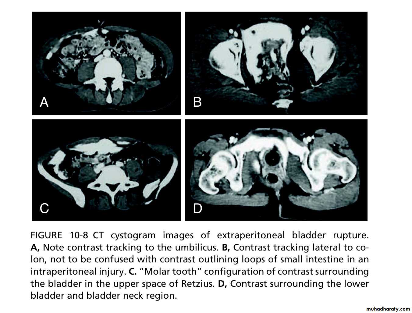 Renal trauma