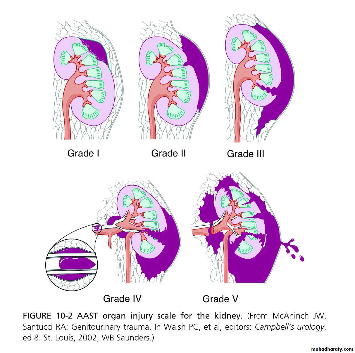 Renal trauma