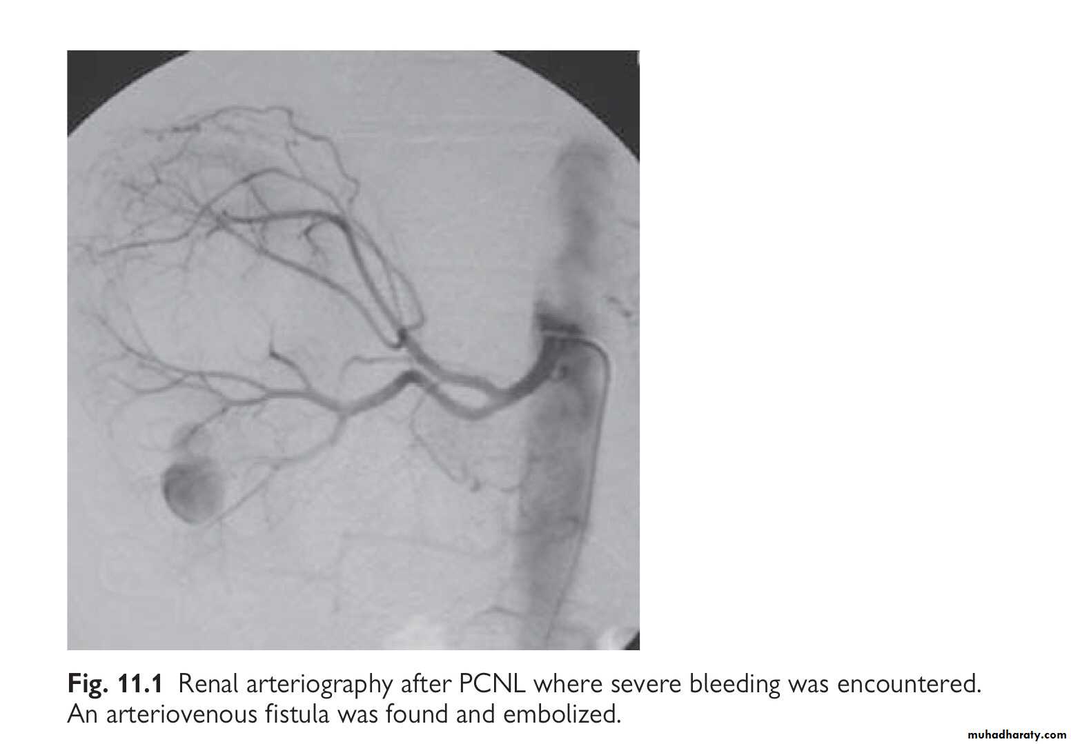 Renal trauma