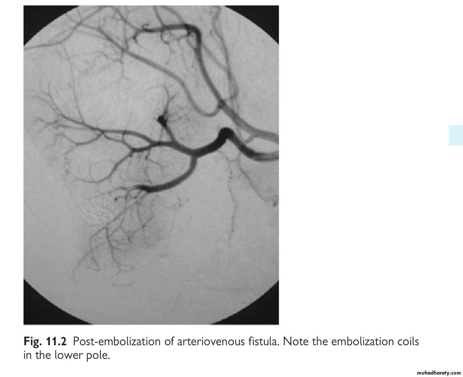 Renal trauma
