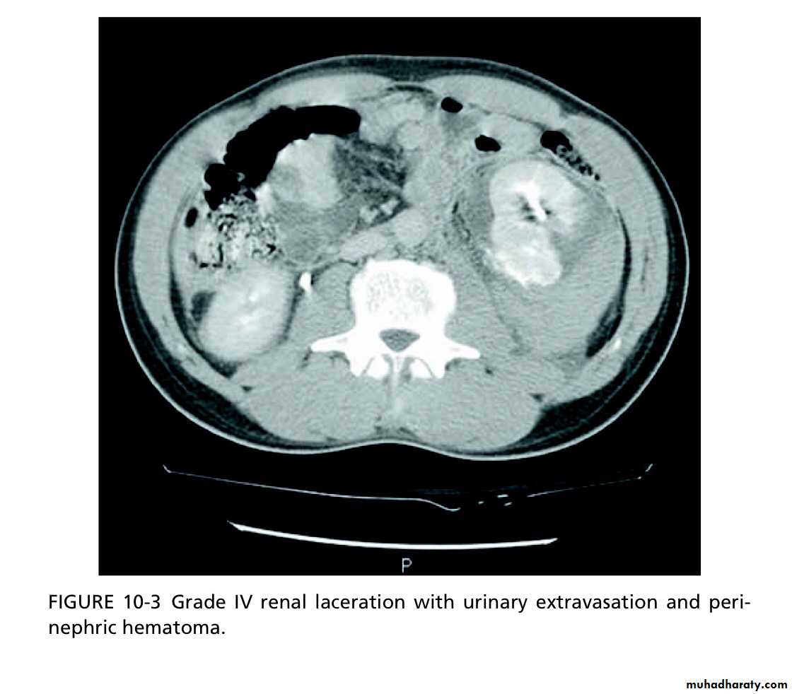 Renal trauma