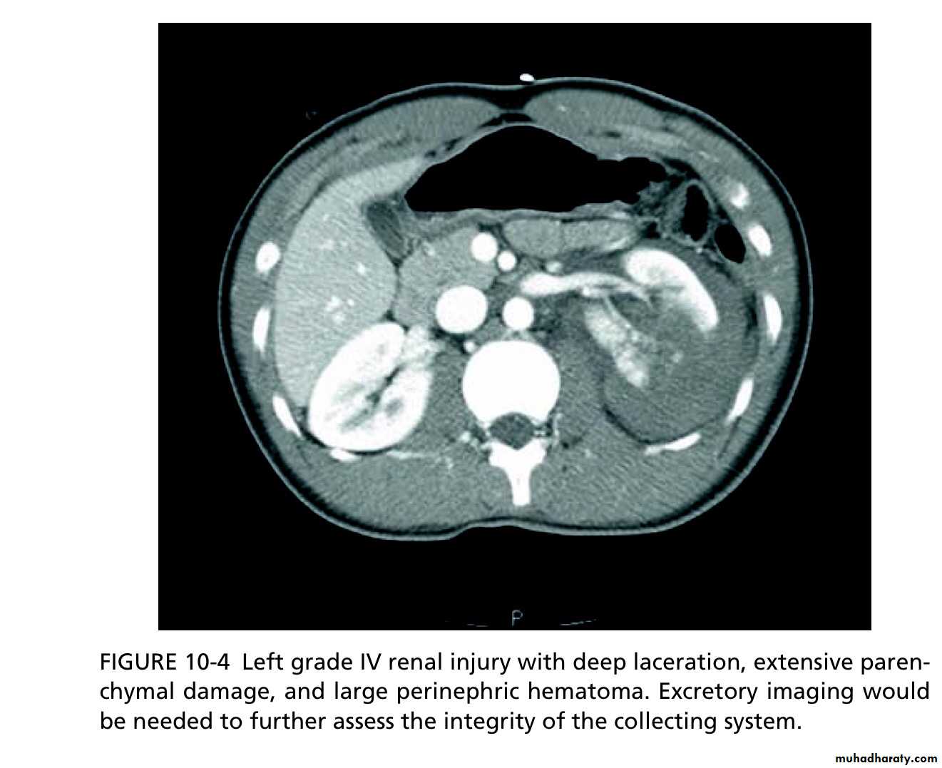 Renal trauma