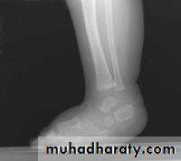 Foot