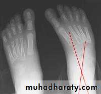 Foot