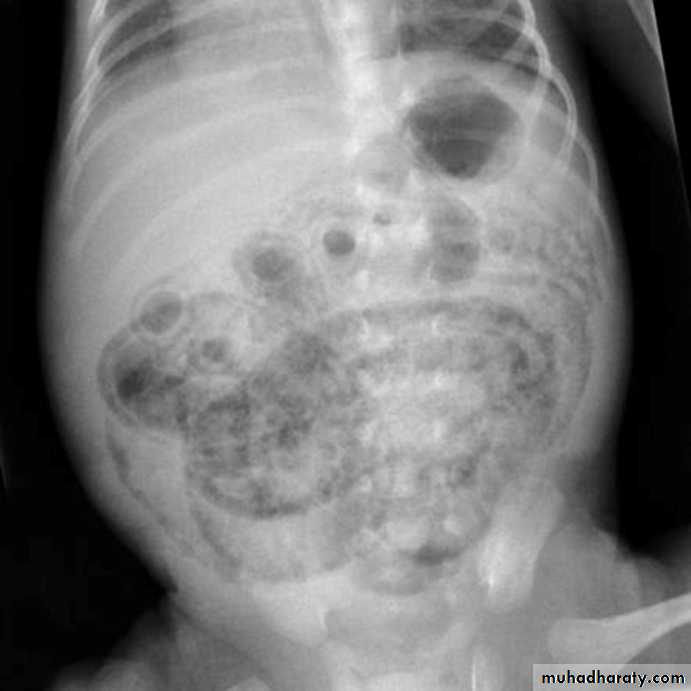 Imaging of GIT diseases