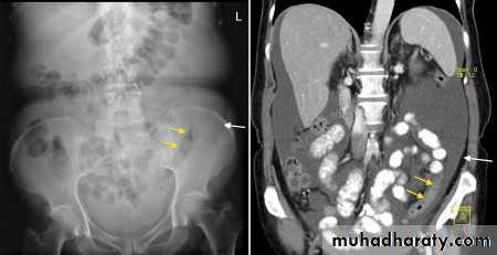 Imaging of GIT diseases