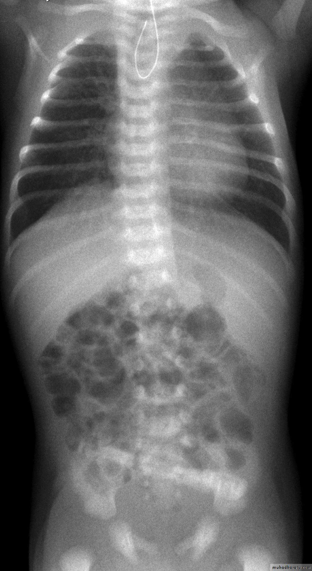 Imaging of GIT diseases