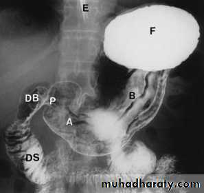 Imaging of GIT diseases