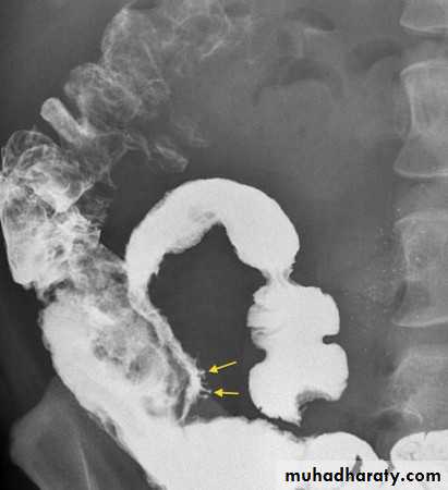 Imaging of GIT diseases