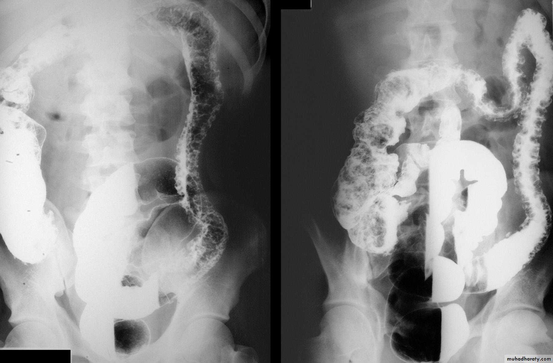 Imaging of GIT diseases