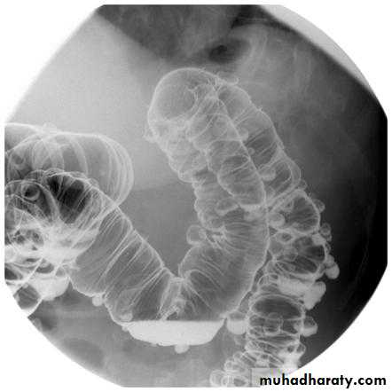 Imaging of GIT diseases