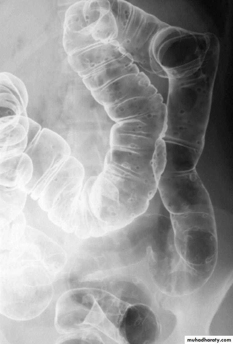 Imaging of GIT diseases
