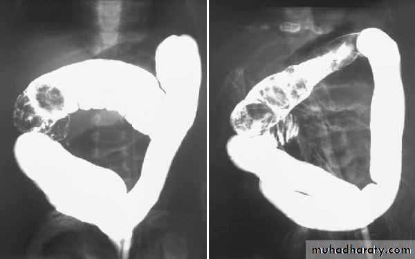 Imaging of GIT diseases