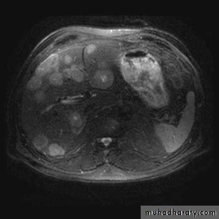 Imaging of GIT diseases