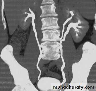 Imaging of urinary tract diseases