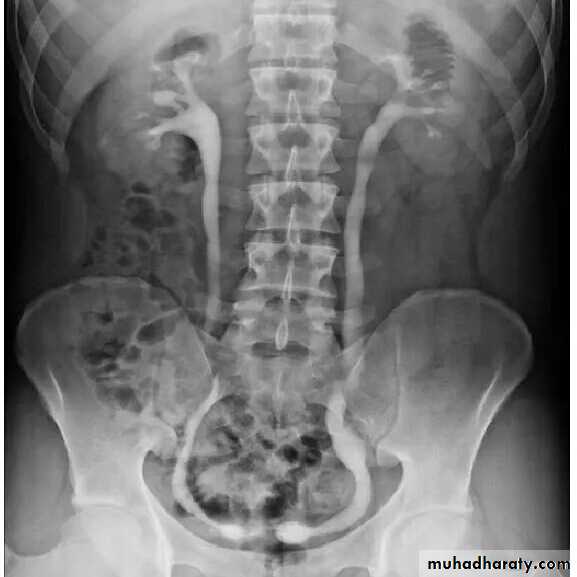 Imaging of urinary tract diseases